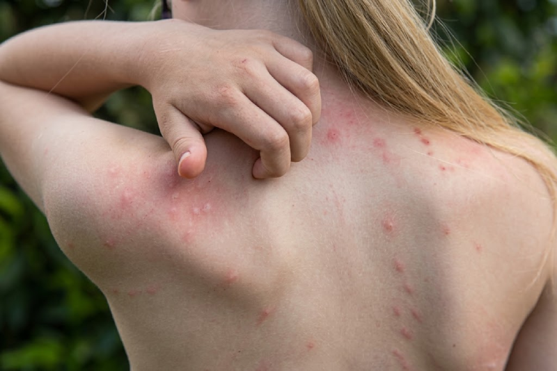 7 حقائق عن أفضل سيروم مبيد لالتهاب قرص البق وكيف تتخلص من الحكة والحشرة فوراً